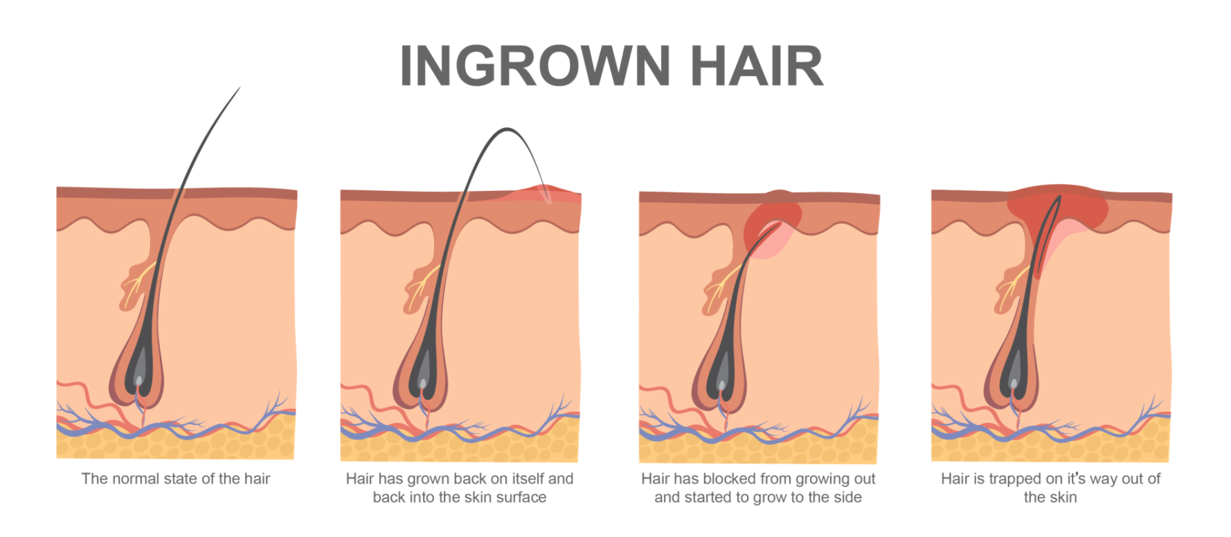 What is an ingrown hair, and how to treat them? - Kelowna Esthetics Studio​  250 859 0394